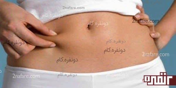 از بین بردن ترک های شکم ناشی از حاملگی و اضافه و کم کردن وزن بصورت ناگهانی