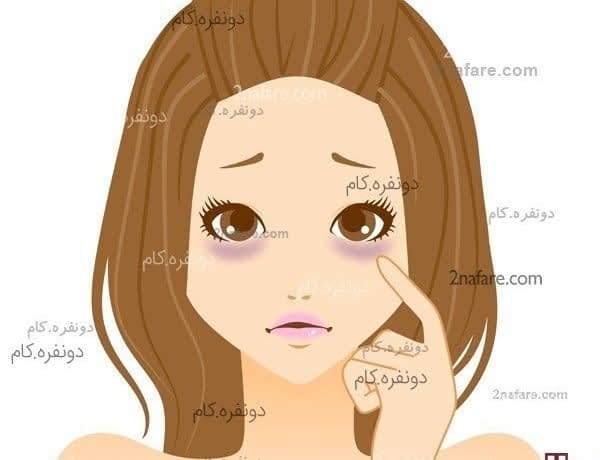 علل اصلی تیرگی دور چشم علت تیرگی دور چشم