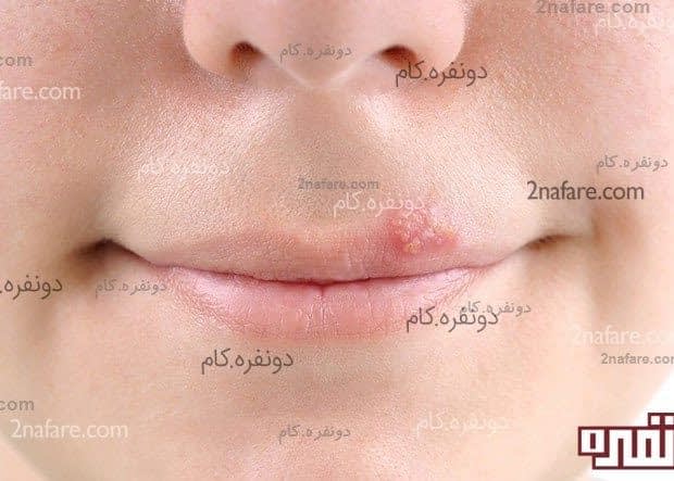 تبخال و چند درمان خانگی موثر تبخال