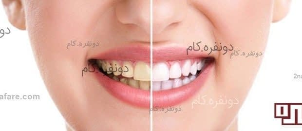 راه هایی برای سفید کردن دندان ها راه های سفید کردن دندان ها