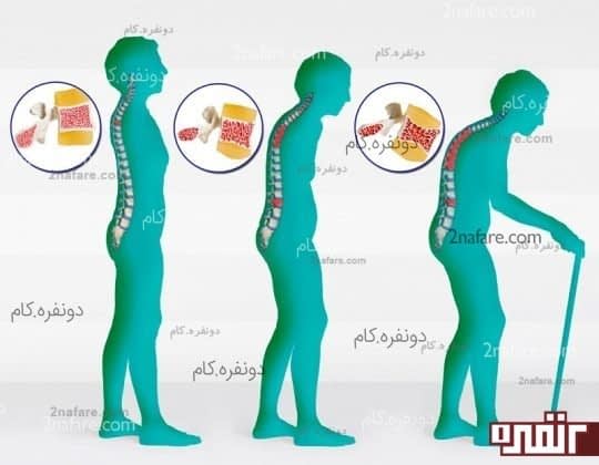 روند ایجاد پوکی استخوان