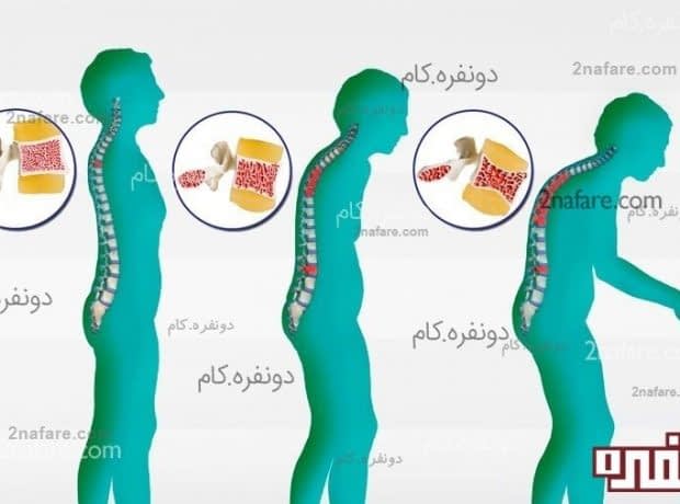 عوامل موثر در ایجاد پوکی استخوان