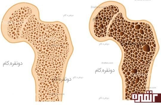 زیاد شدن حفره های استخوان