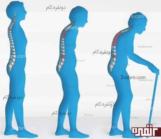 پوکی استخوان