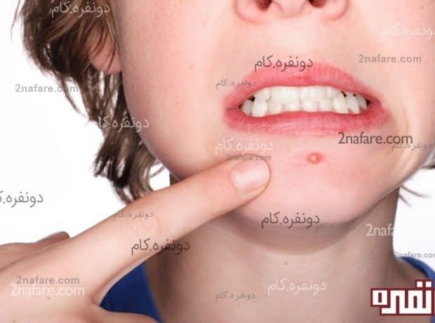 شایع ترین علل ایجاد جوش و پیشگیری از آن شایع ترین علل ایجاد جوش و پیشگیری از آن