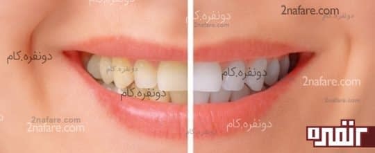 با استفاده از پوست موز دندانهایی سفید داشته باشید