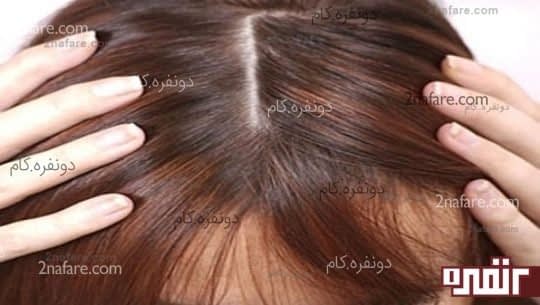 پوست آسیب دیده ی سر باعث توقف رشد موها میشود