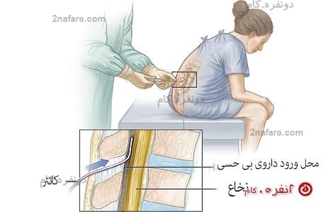 تزریق نخاعی