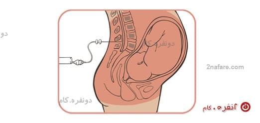 زایمان اپیدورال