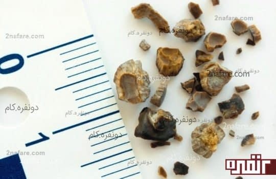 جلوگیری از سنگ کلیه و عفونت مثانه