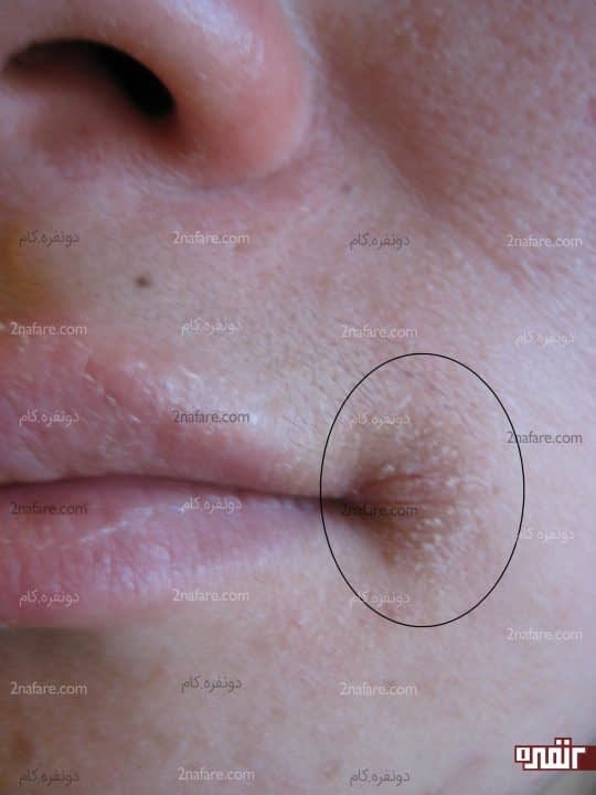 ترک خوردگی گوشه دهان