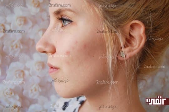 جوش های سفید و قرمز روی گونه ها