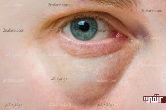 چشم هایی پف آلود