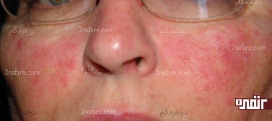 کهیر ها و دانه های قرمز روی پوست صورت