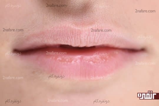 رنگ پریدگی لب ها