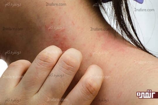 علائم اگزما روی گردن