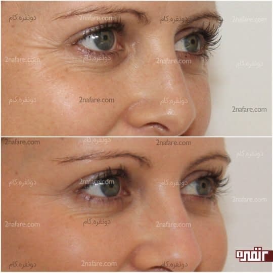 مزایای تزریق اپریلاین