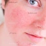 بهترین روش های درمان طبیعی قرمزی پوست