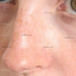 7 درمان خانگی برای از بین بردن لکه های قهوه ای روی بینی