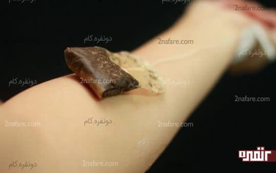 کمک به درمان تاول و سوختگی