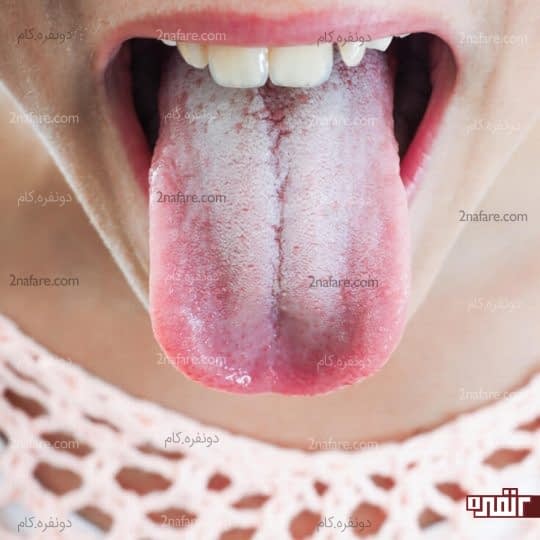 لایه سفید روی زبان