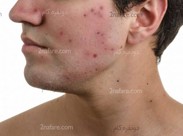 9 روش خانگی برای درمان آکنه روش خانگی برای درمان آکنه