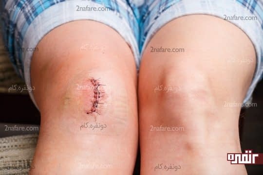 به بهتر شدن سریع زخم کمک میکنه