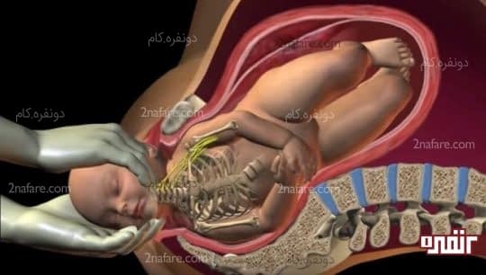 دیستوشی شانه و بزرگ بودن نوزاد از علل گیر کردن نوزاد