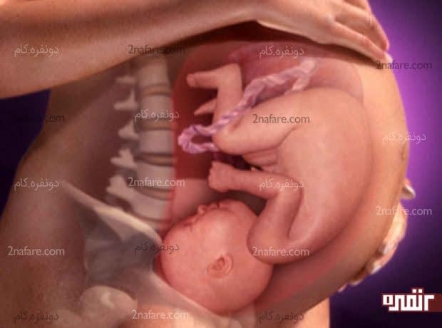 علل اصلی گیر کردن نوزاد حین زایمان طبیعی