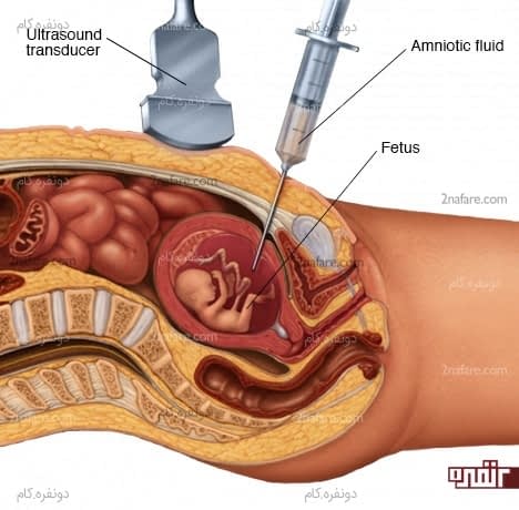 اولتراسوند و تعیین سلامت جنین و مایع آمنیوتیک