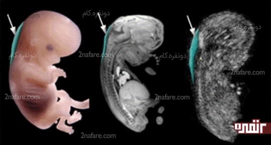 اسکن نیمه شفاف و اندازه گیری مایع پشت گردن جنین