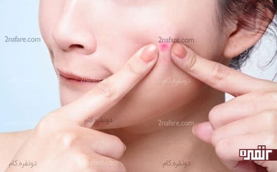 درمان جوش و آکنه در بارداری