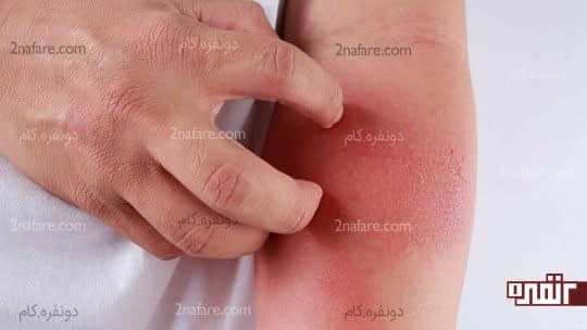 درمان گیاهی التهاب پوست با شنبلیله