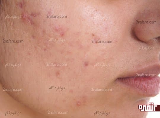 درمانی مفید برای اختلالات پوستی