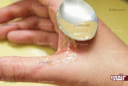سفیده تخم مرغ در درمان سوختگی