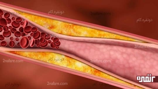 علت های موثر در چربی خون بالا در بدن