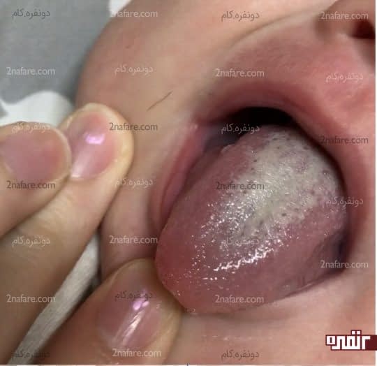 علل برفک دهان در نوزادان