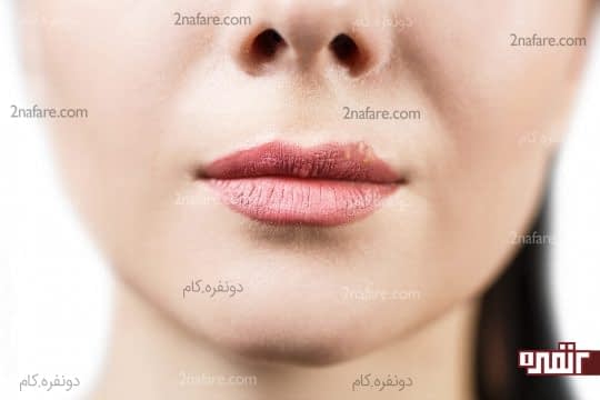 تبخال