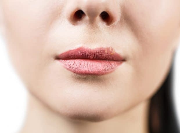 راهکارهای پیشگیری و درمان تبخال تبخال