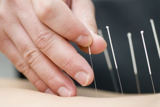 کاهش وزن با استفاده از طب سوزنی