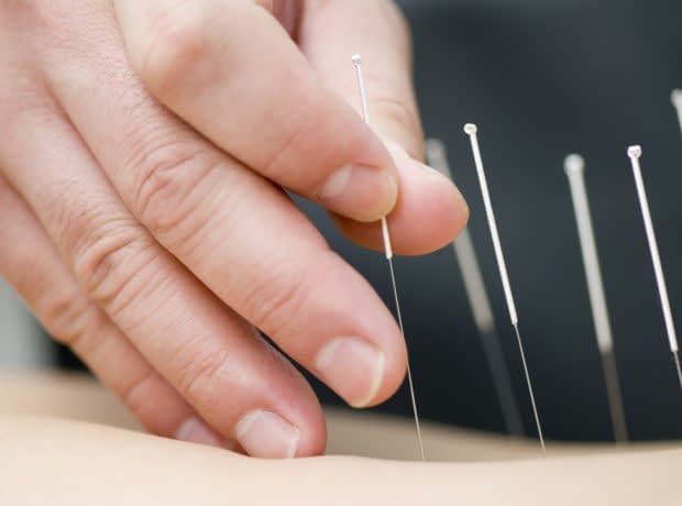 استفاده از طب سوزنی برای کاهش وزن کاهش وزن با استفاده از طب سوزنی