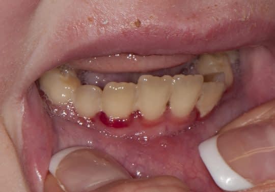 اسکوروی(Scurvy) را درمان میکند