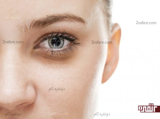 جلوگیری از سیاه شدن زیر چشم