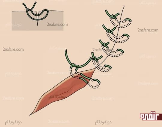 دوخت زیر پوستی