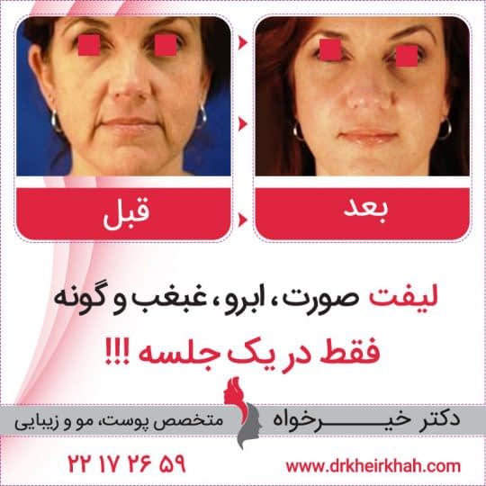 قبل و بعد از عمل