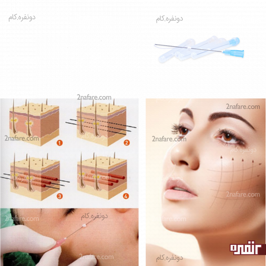 روش لیفت با نخ چگونه است؟