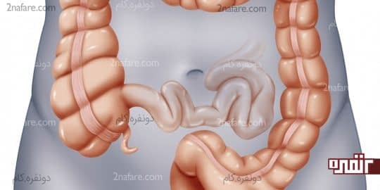 عامل موثر در پیشگیری از سرطان