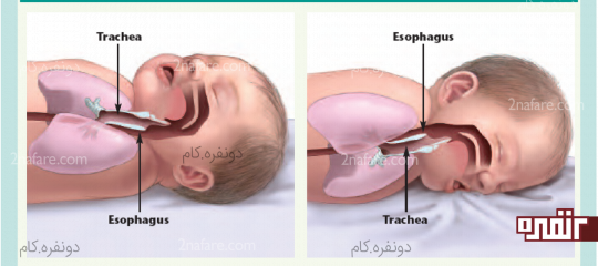 کاهش خطر سندروم مرگ ناگهانی
