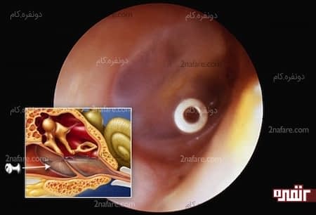 کاشتن لوله های تمپانوستومی یا تهویه گوش