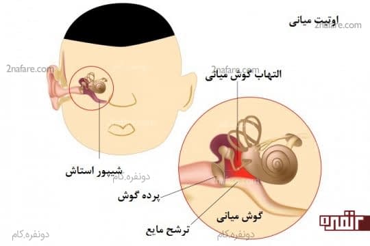 عفونت گوش میانی